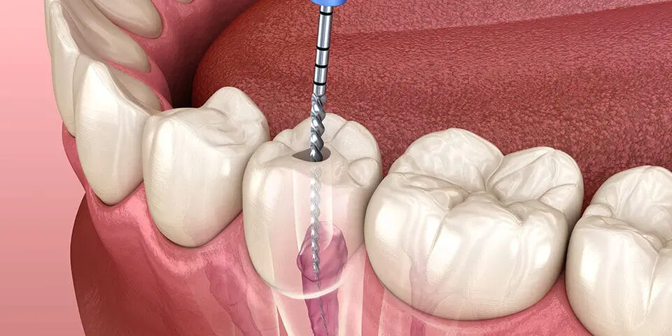 Root Canal Treatment RCT in Bhadrak